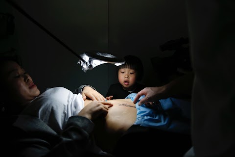 Chinese mothers tattoo over C-section scars