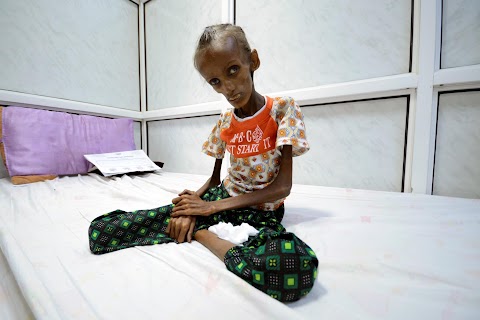 Severe malnutrition in Yemen